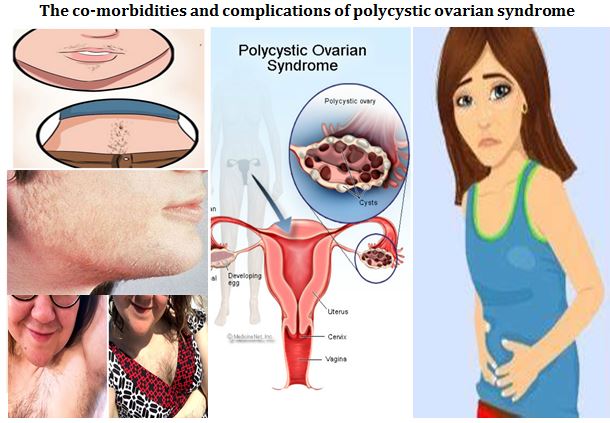 A study to assess the co-morbidities and complications of polycystic ovarian syndrome 