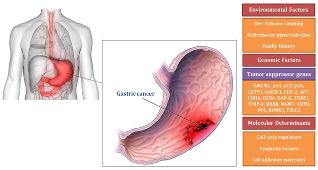 Molecular and clinical analysis of genes involved in gastric cancer 