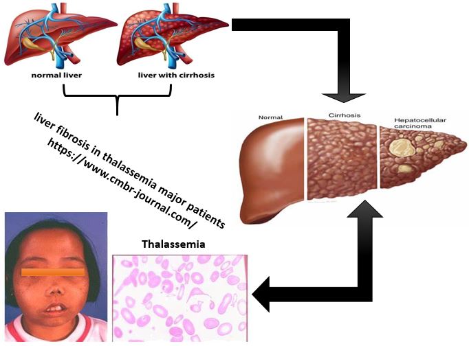Investigation of non-invasive indicators of liver fibrosis in thalassemia major patients 